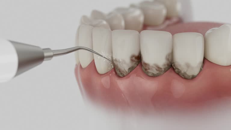 Reliable Dental Implants contractor in Oakdale, LA by Smile Center Dentistry